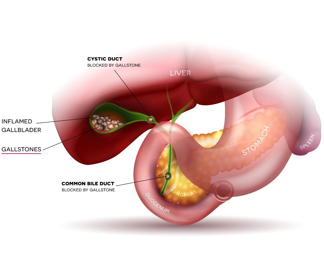 Gallbladder Stones